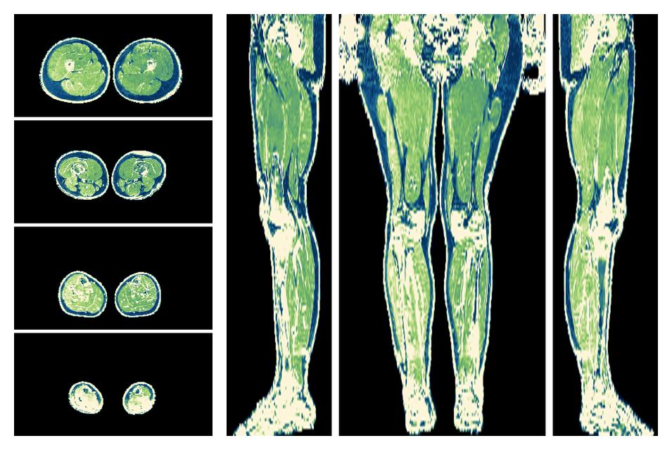 The R2 star relaxation time of the lower extremity obtained from the dixon reconstruction for muscle water fat quantification.