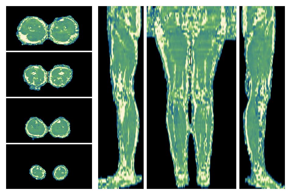 The water only T2 relaxation time of the lower extremity obtained from multi echo spin echo t2 mapping with EPG based reconstruction.