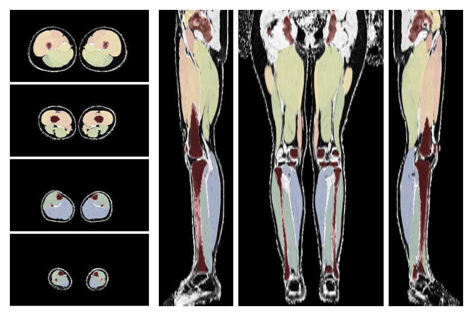 Overlay of automated muscle segmentation labels on dixon water image.