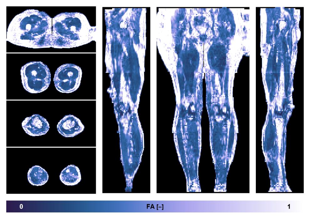 IVIM corrected whole leg muscle fractional anisotropy obtained from diffusion tensor imaging.