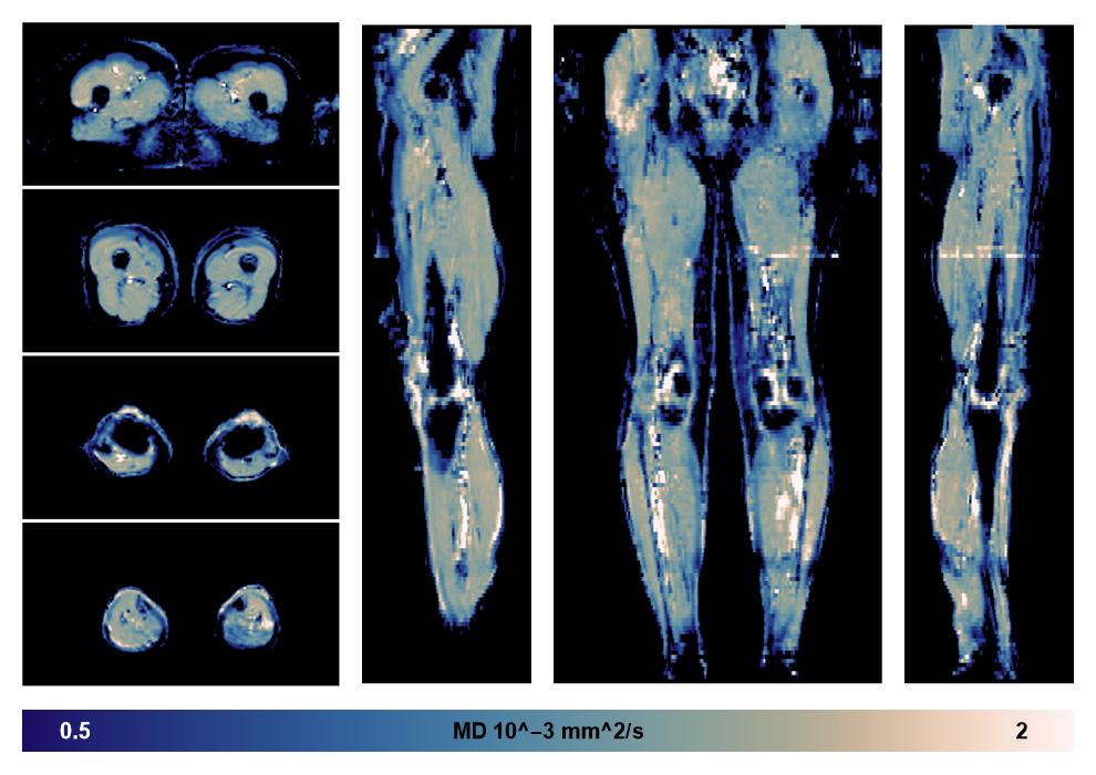 IVIM corrected whole leg muscle mean diffusivity obtained from diffusion tensor imaging.