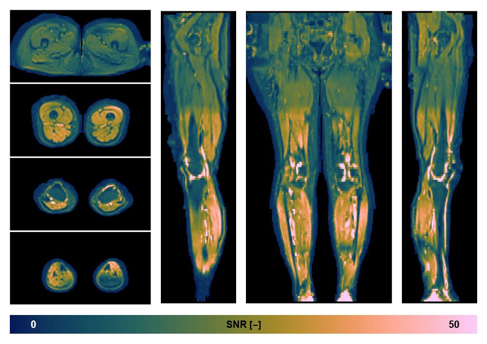 SNR distribution of the unweighted diffusion data.