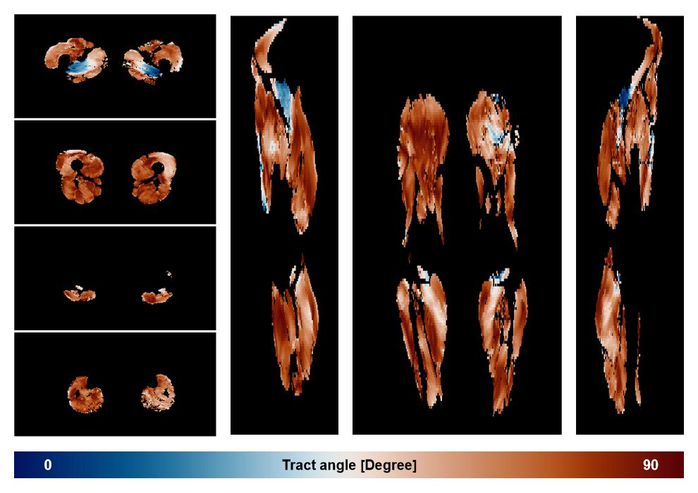 Muscle fiber tract angle map based on whole leg DTI based fiber tractography.