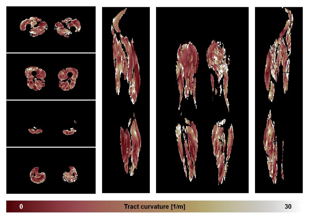 Muscle fiber tract curvature map based on whole leg DTI based fiber tractography.