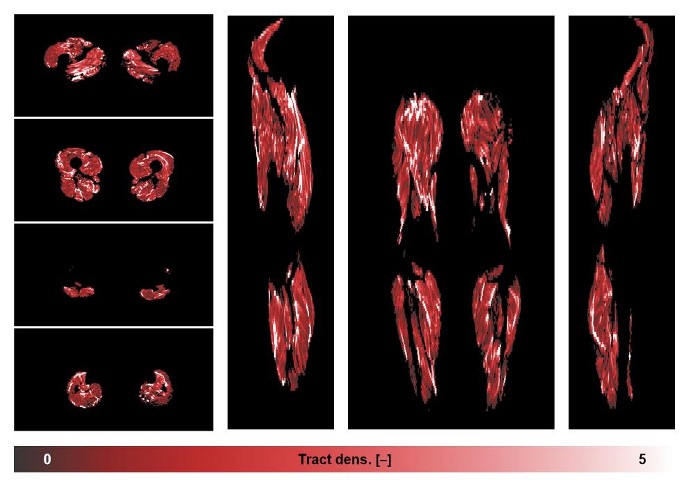 Muscle fiber tract density map based on whole leg DTI based fiber tractography.