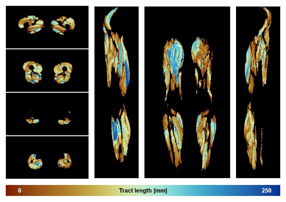 Muscle fiber tract length map based on whole leg DTI based fiber tractography.