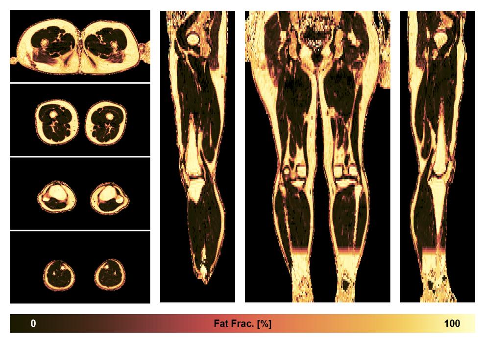 The fat fraction of the lower extremity obtained from the dixon reconstruction for muscle water fat quantification.