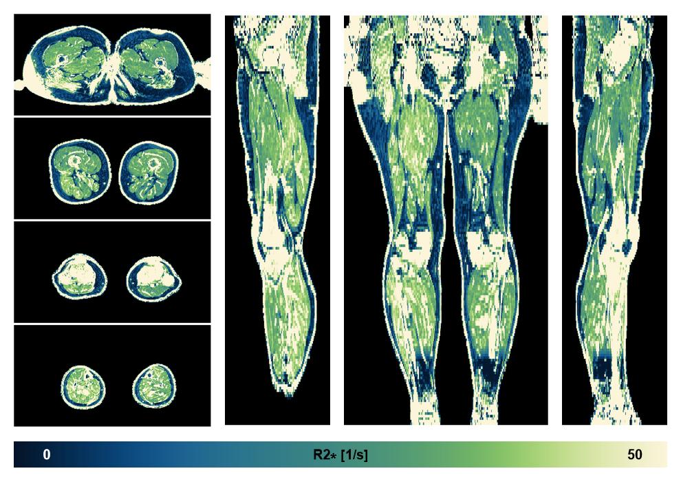 The R2 star relaxation time of the lower extremity obtained from the dixon reconstruction for muscle water fat quantification.