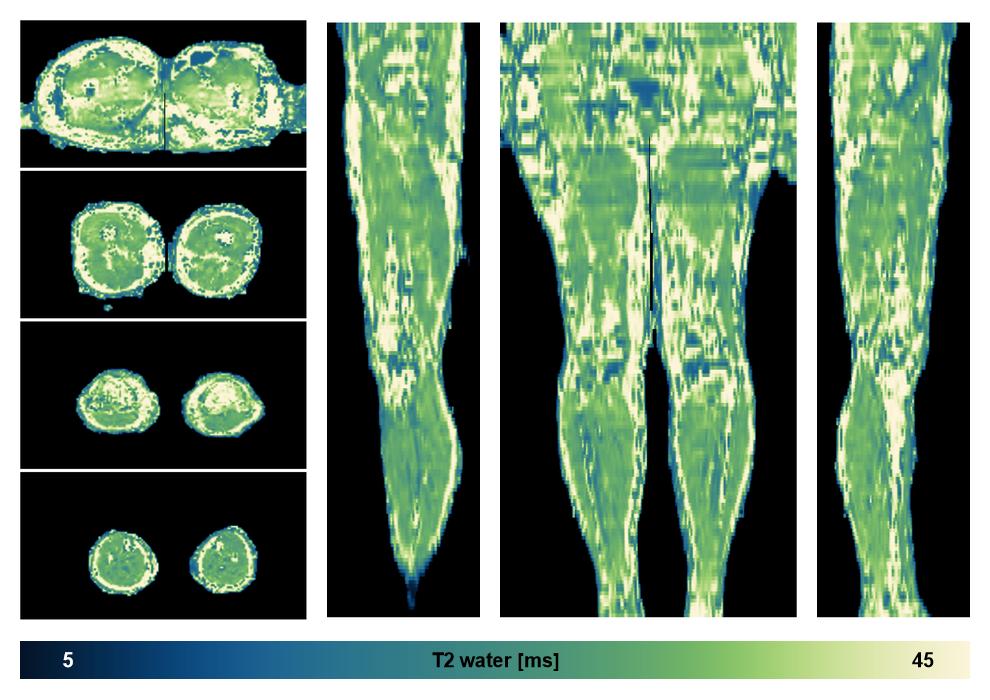 The water only T2 relaxation time of the lower extremity obtained from multi echo spin echo t2 mapping with EPG based reconstruction.