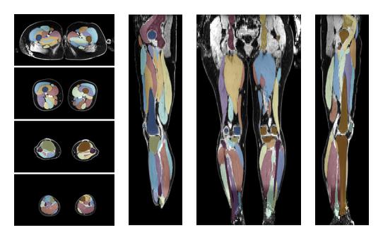 Overlay of automated muscle segmentation labels on dixon water image.