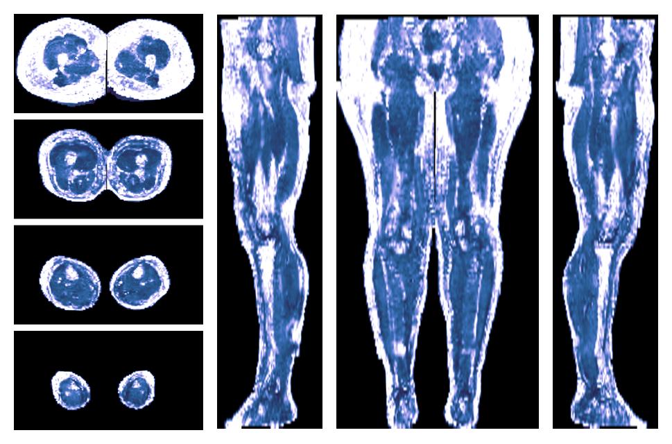 IVIM corrected whole leg muscle fractional anisotropy obtained from diffusion tensor imaging.