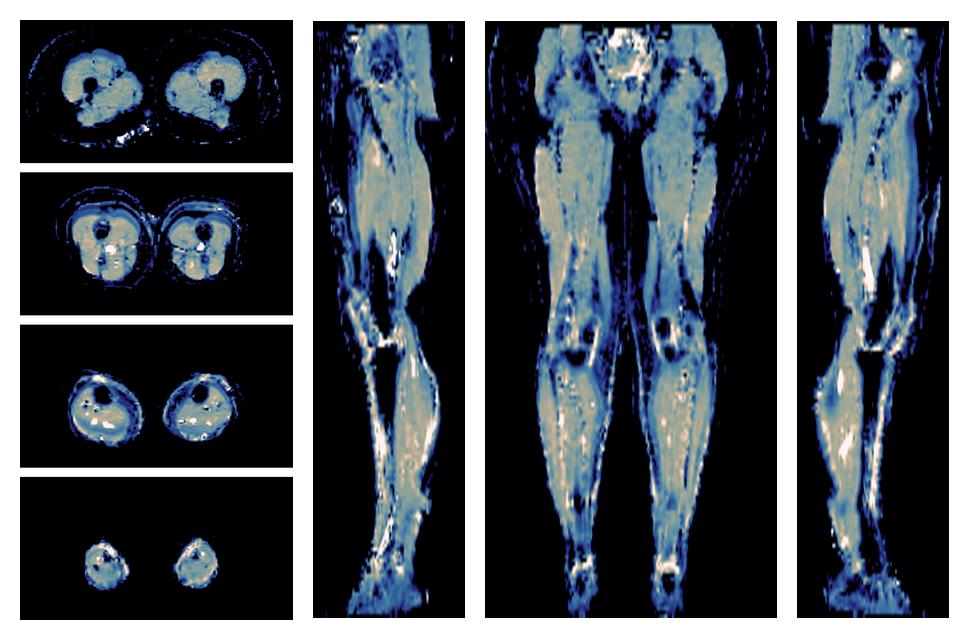 IVIM corrected whole leg muscle mean diffusivity obtained from diffusion tensor imaging.