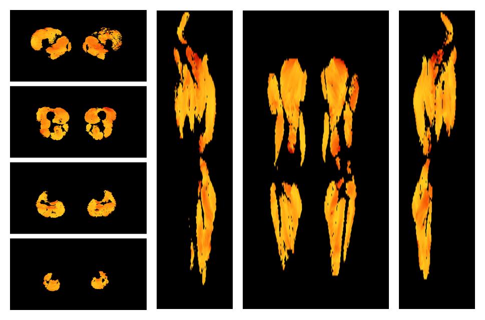 Muscle fiber tract angle map based on whole leg DTI based fiber tractography.