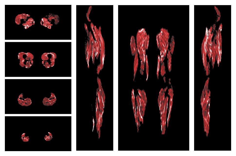 Muscle fiber tract density map based on whole leg DTI based fiber tractography.