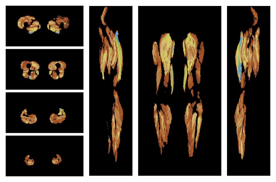 Muscle fiber tract length map based on whole leg DTI based fiber tractography.