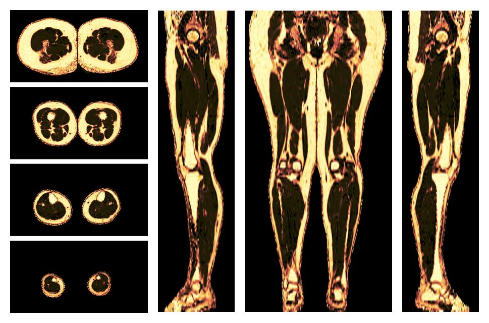 The fat fraction of the lower extremity obtained from the dixon reconstruction for muscle water fat quantification.