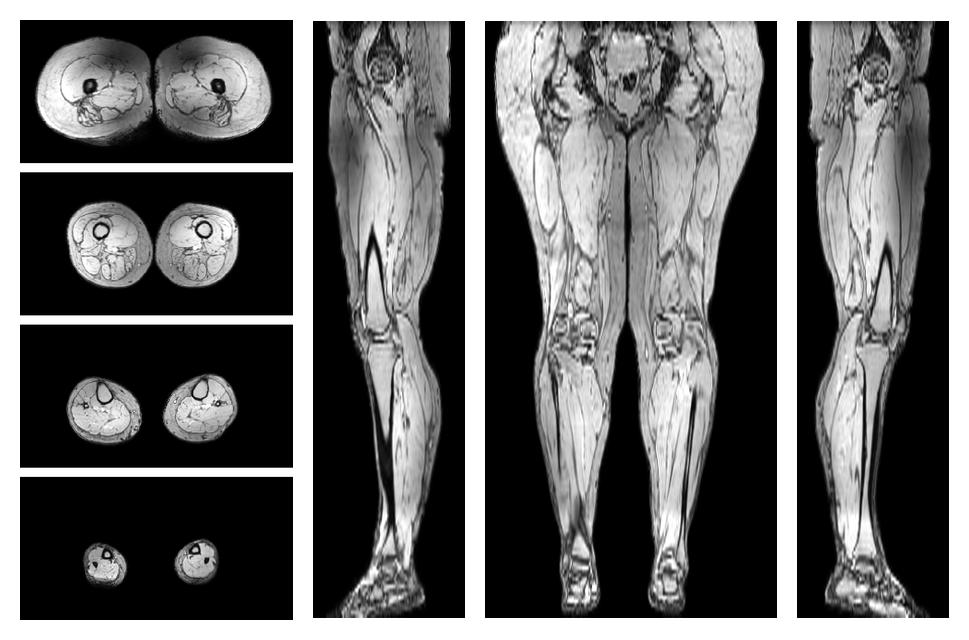 The out-phase image of the dixon reconstruction for water fat quantification.