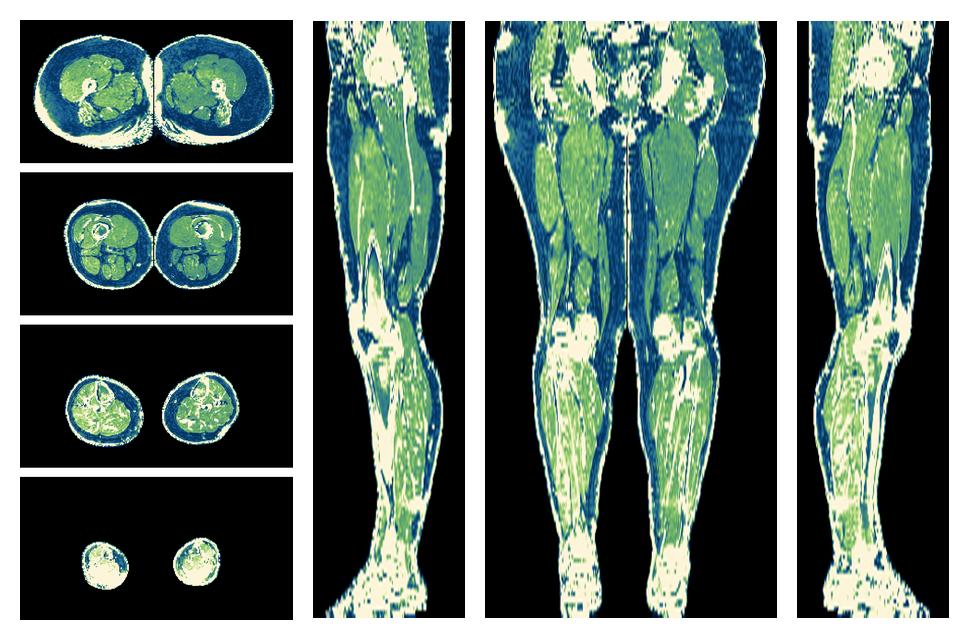 The R2 star relaxation time of the lower extremity obtained from the dixon reconstruction for muscle water fat quantification.