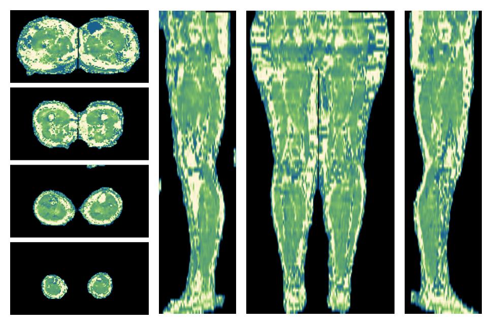 The water only T2 relaxation time of the lower extremity obtained from multi echo spin echo t2 mapping with EPG based reconstruction.