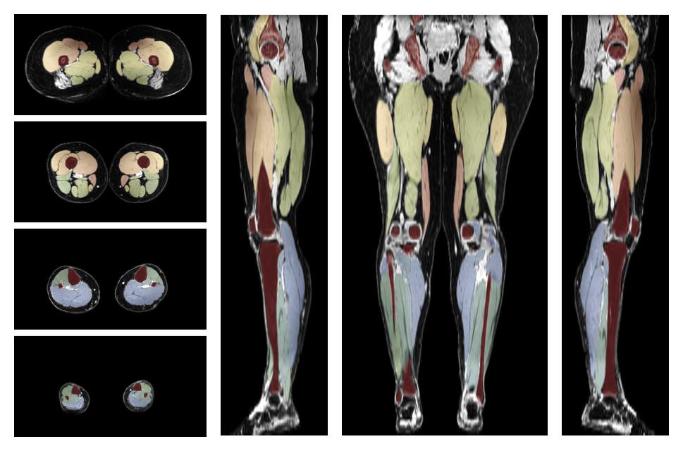 Overlay of automated muscle segmentation labels on dixon water image.