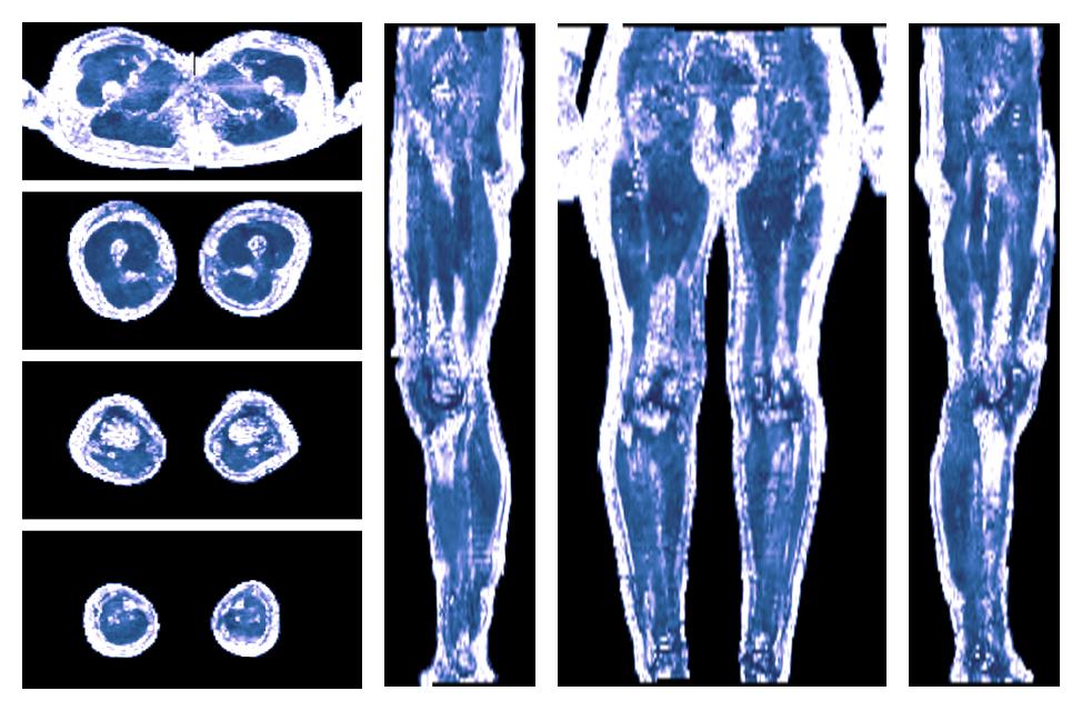 IVIM corrected whole leg muscle fractional anisotropy obtained from diffusion tensor imaging.