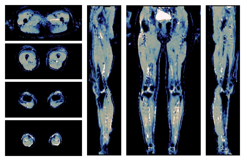 IVIM corrected whole leg muscle mean diffusivity obtained from diffusion tensor imaging.