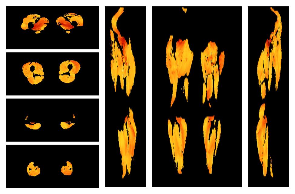 Muscle fiber tract angle map based on whole leg DTI based fiber tractography.