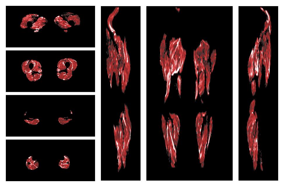 Muscle fiber tract density map based on whole leg DTI based fiber tractography.