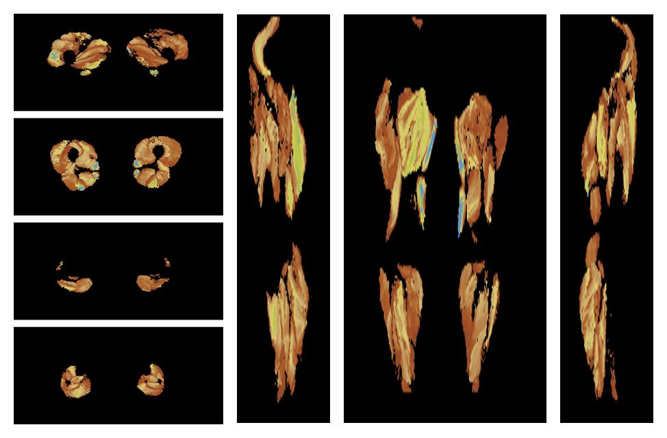 Muscle fiber tract length map based on whole leg DTI based fiber tractography.