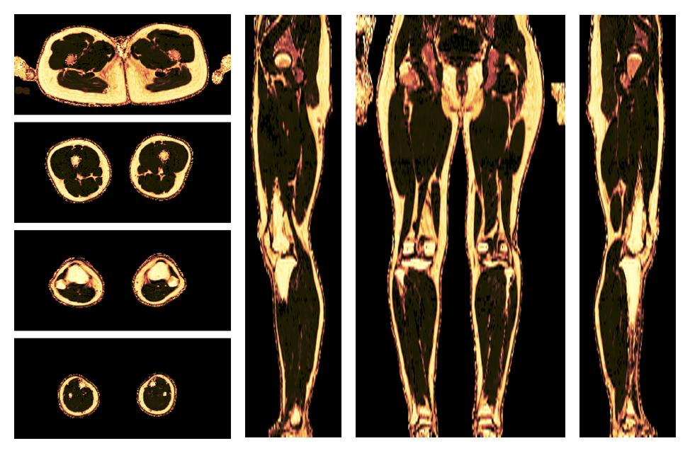 The fat fraction of the lower extremity obtained from the dixon reconstruction for muscle water fat quantification.