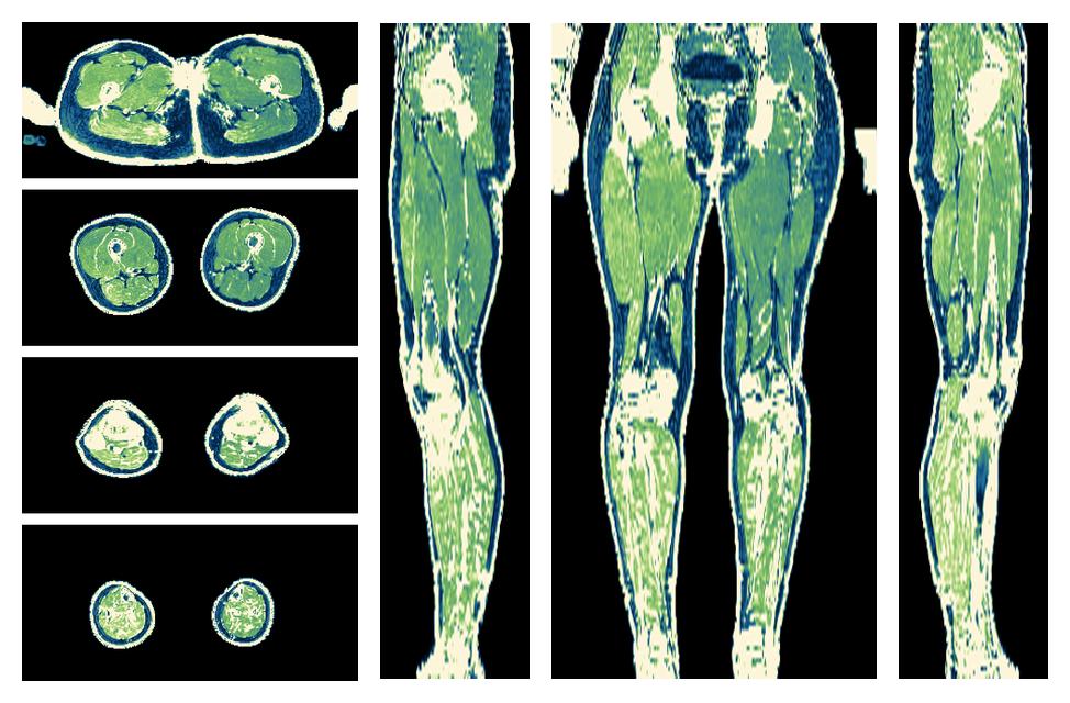 The R2 star relaxation time of the lower extremity obtained from the dixon reconstruction for muscle water fat quantification.