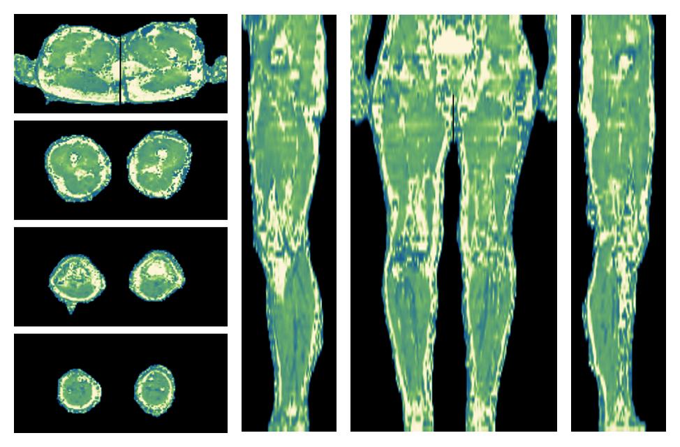 The water only T2 relaxation time of the lower extremity obtained from multi echo spin echo t2 mapping with EPG based reconstruction.