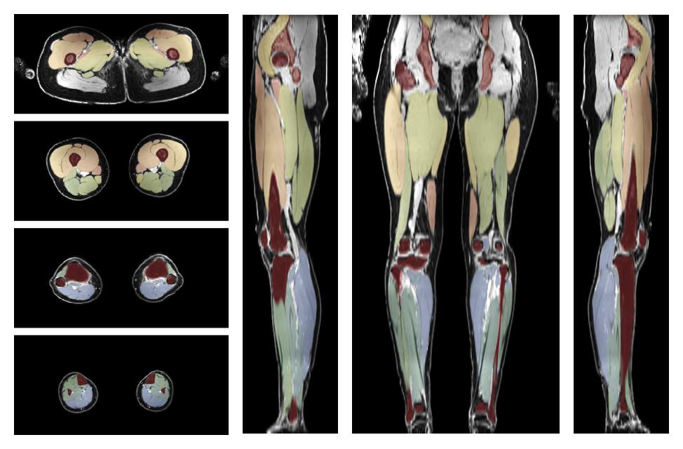 Overlay of automated muscle segmentation labels on dixon water image.