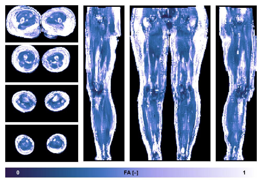 IVIM corrected whole leg muscle fractional anisotropy obtained from diffusion tensor imaging.