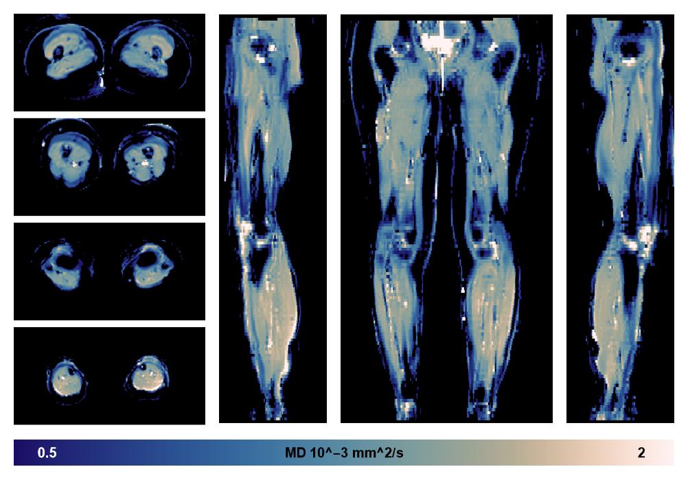 IVIM corrected whole leg muscle mean diffusivity obtained from diffusion tensor imaging.