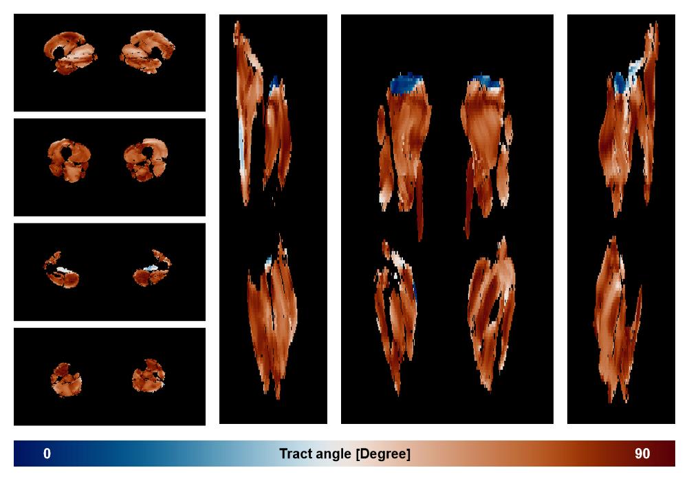 Muscle fiber tract angle map based on whole leg DTI based fiber tractography.