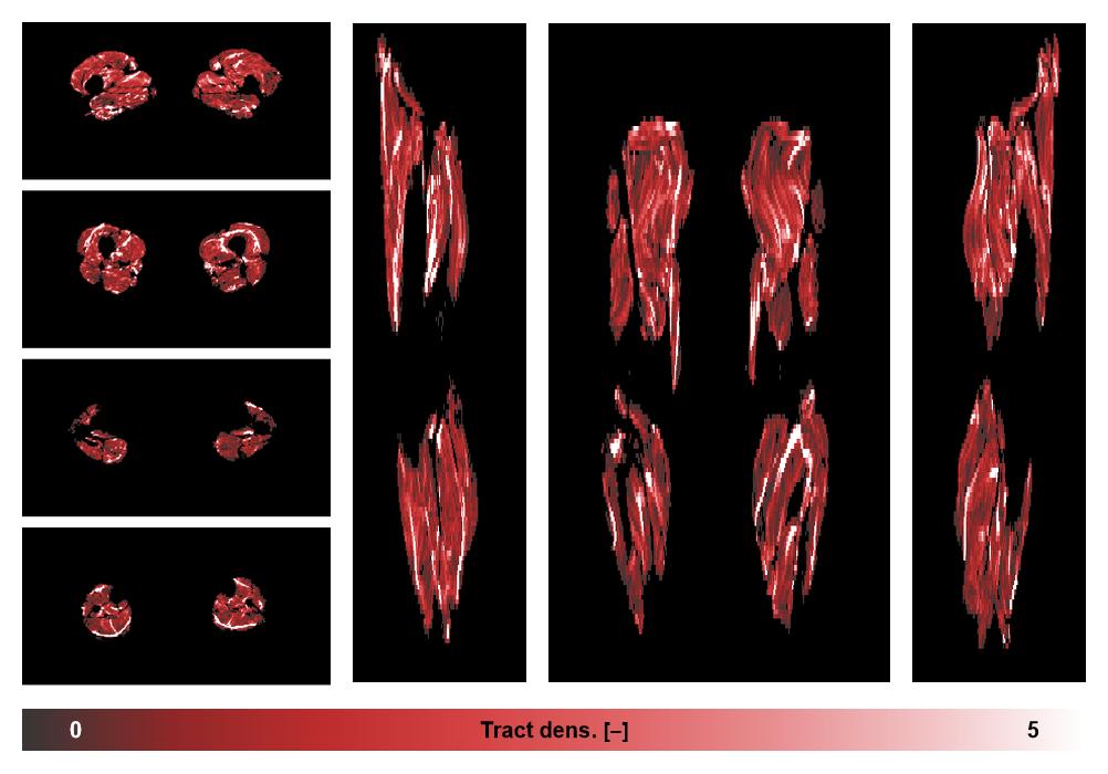 Muscle fiber tract density map based on whole leg DTI based fiber tractography.