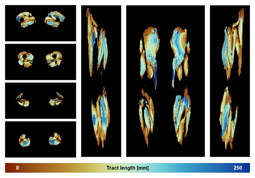 Muscle fiber tract length map based on whole leg DTI based fiber tractography.