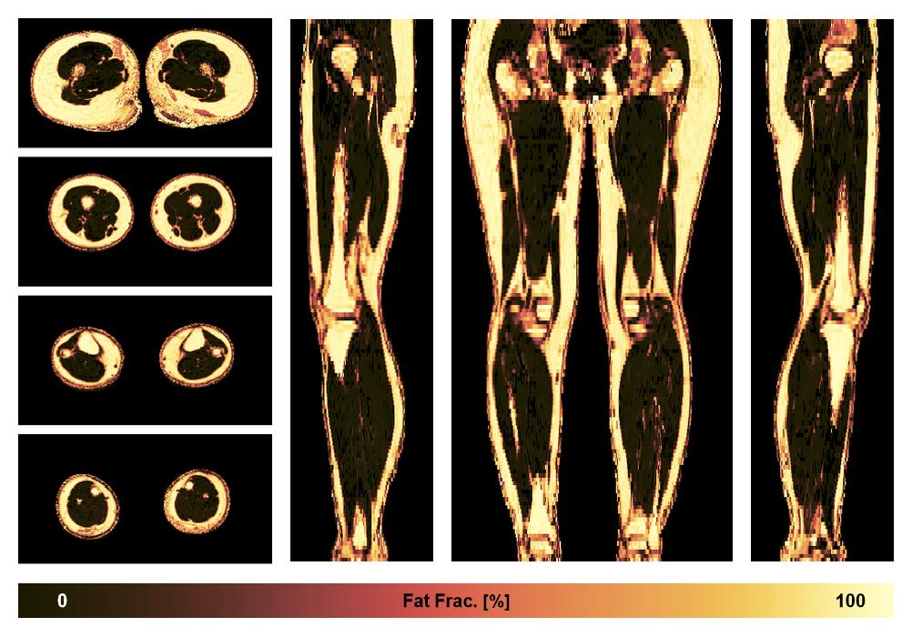 The fat fraction of the lower extremity obtained from the dixon reconstruction for muscle water fat quantification.