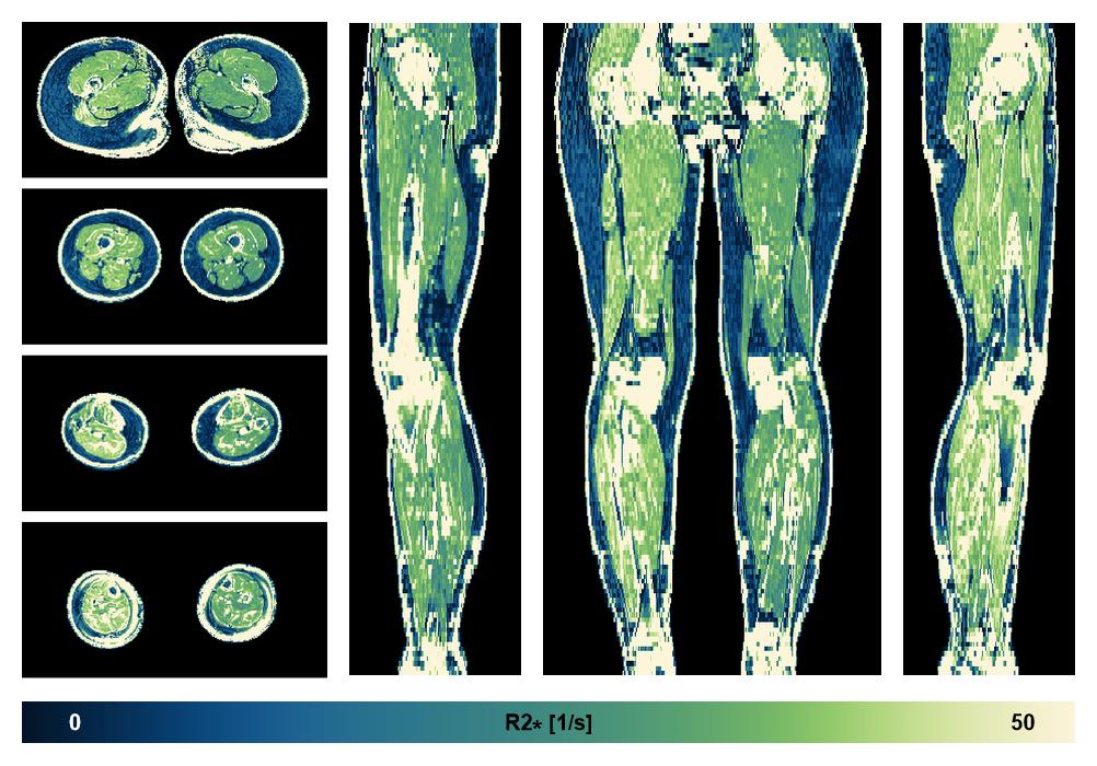 The R2 star relaxation time of the lower extremity obtained from the dixon reconstruction for muscle water fat quantification.