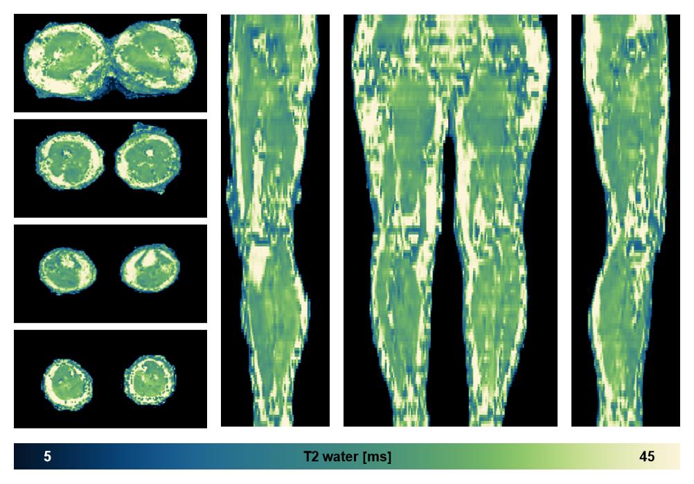 The water only T2 relaxation time of the lower extremity obtained from multi echo spin echo t2 mapping with EPG based reconstruction.