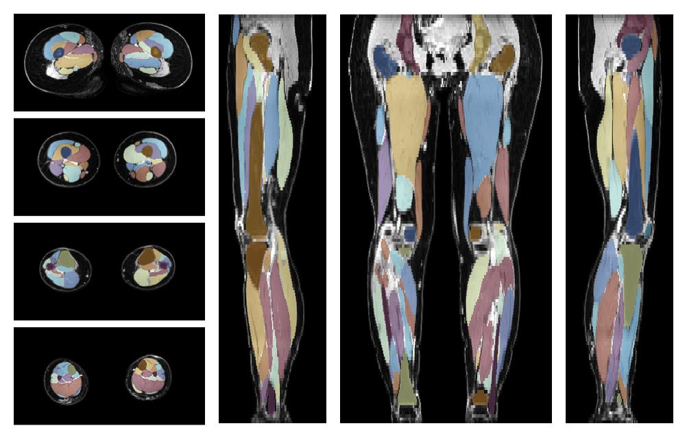 Overlay of automated muscle segmentation labels on dixon water image.