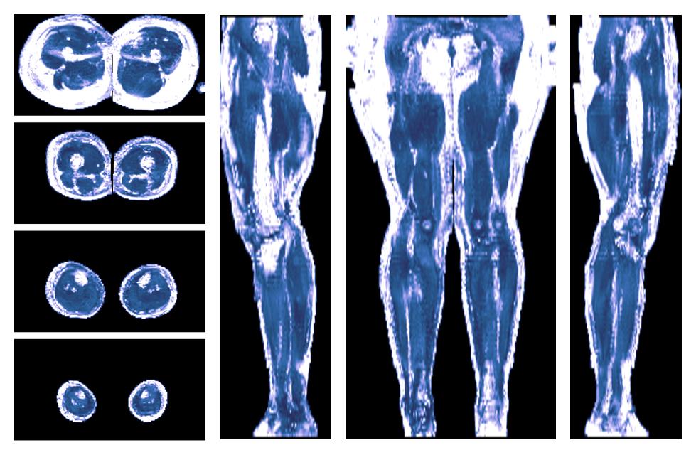 IVIM corrected whole leg muscle fractional anisotropy obtained from diffusion tensor imaging.