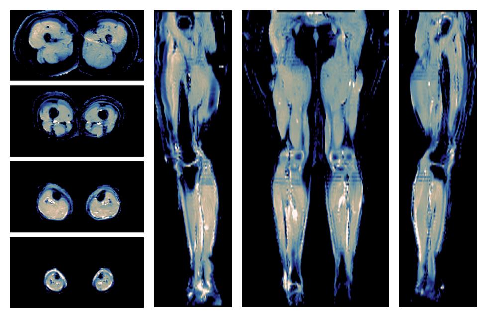 IVIM corrected whole leg muscle mean diffusivity obtained from diffusion tensor imaging.