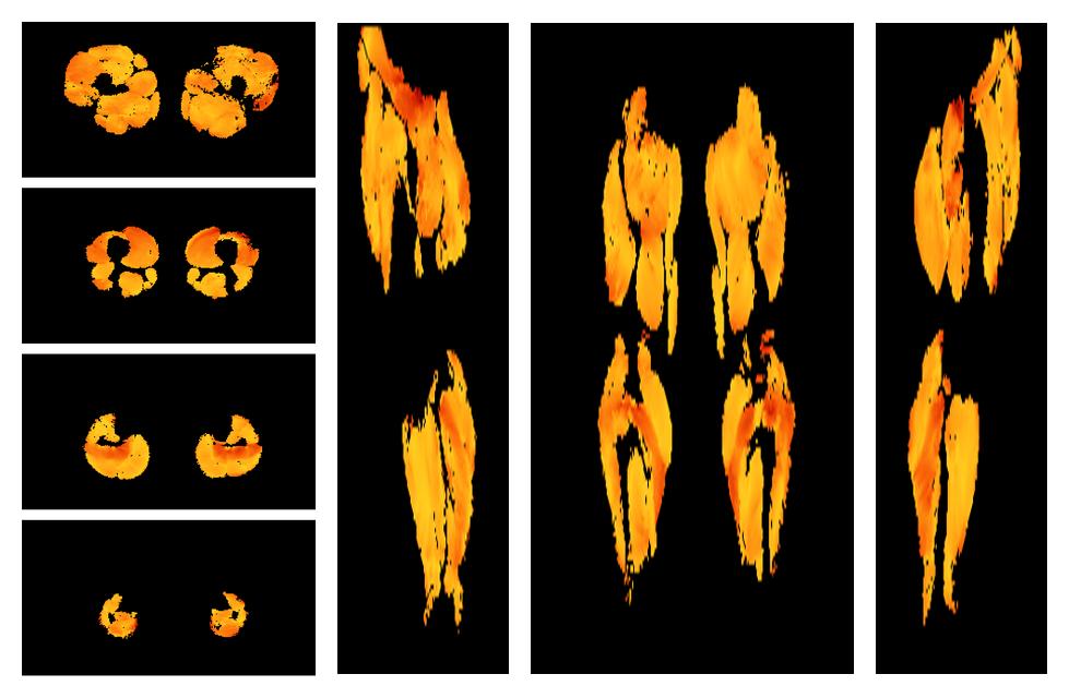 Muscle fiber tract angle map based on whole leg DTI based fiber tractography.