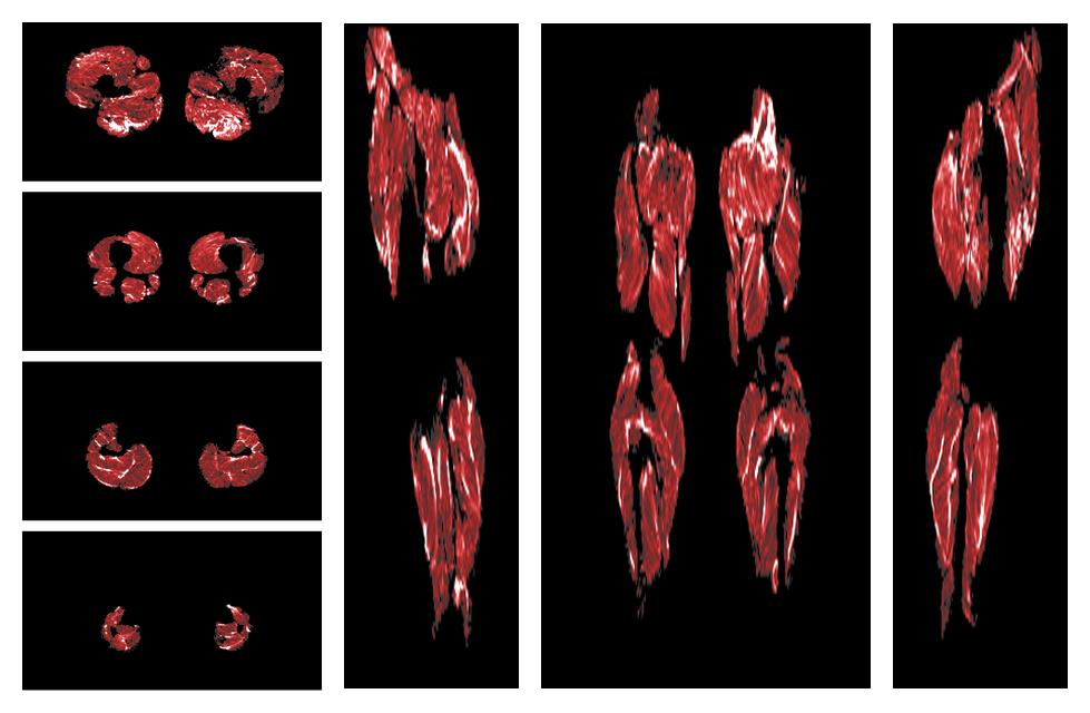 Muscle fiber tract density map based on whole leg DTI based fiber tractography.