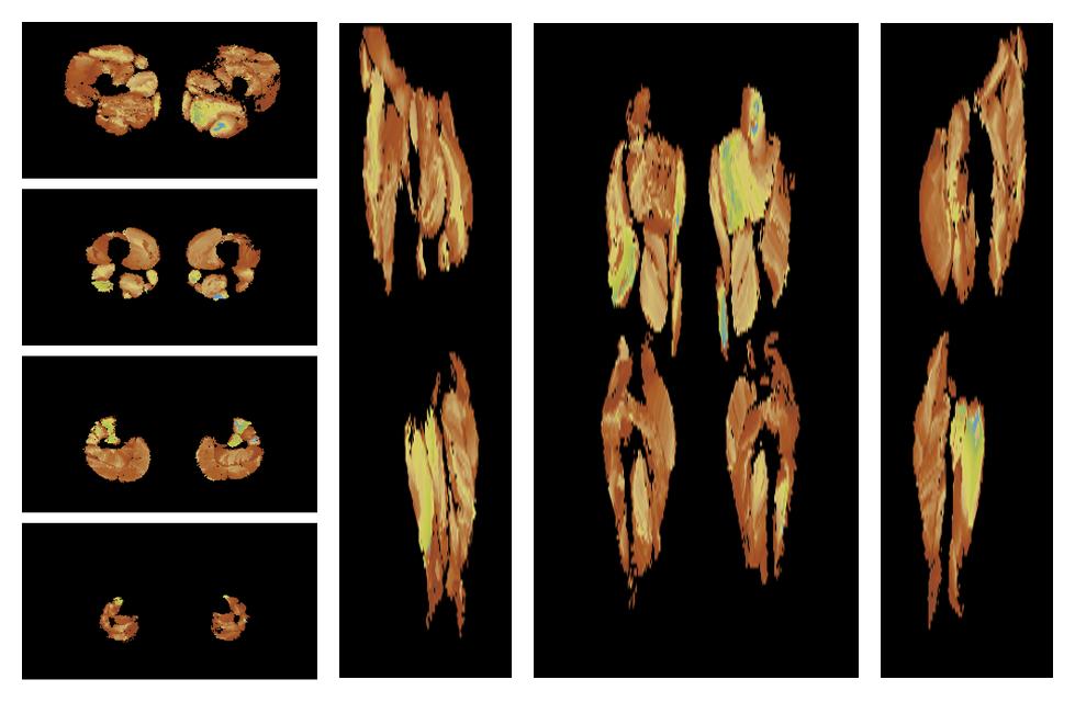 Muscle fiber tract length map based on whole leg DTI based fiber tractography.