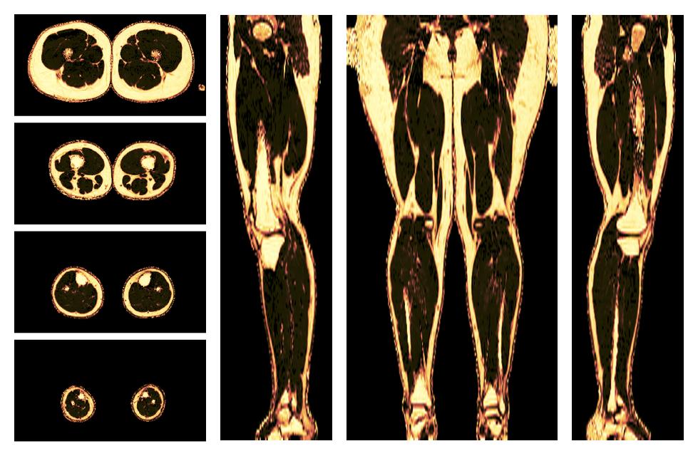 The fat fraction of the lower extremity obtained from the dixon reconstruction for muscle water fat quantification.