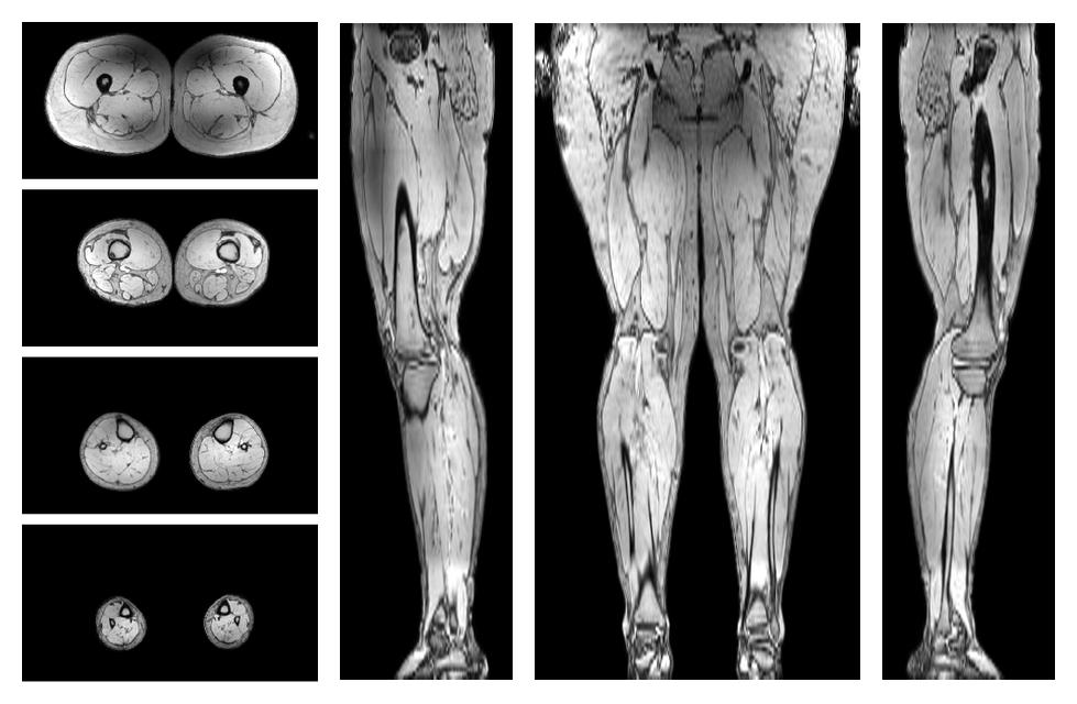 The out-phase image of the dixon reconstruction for water fat quantification.