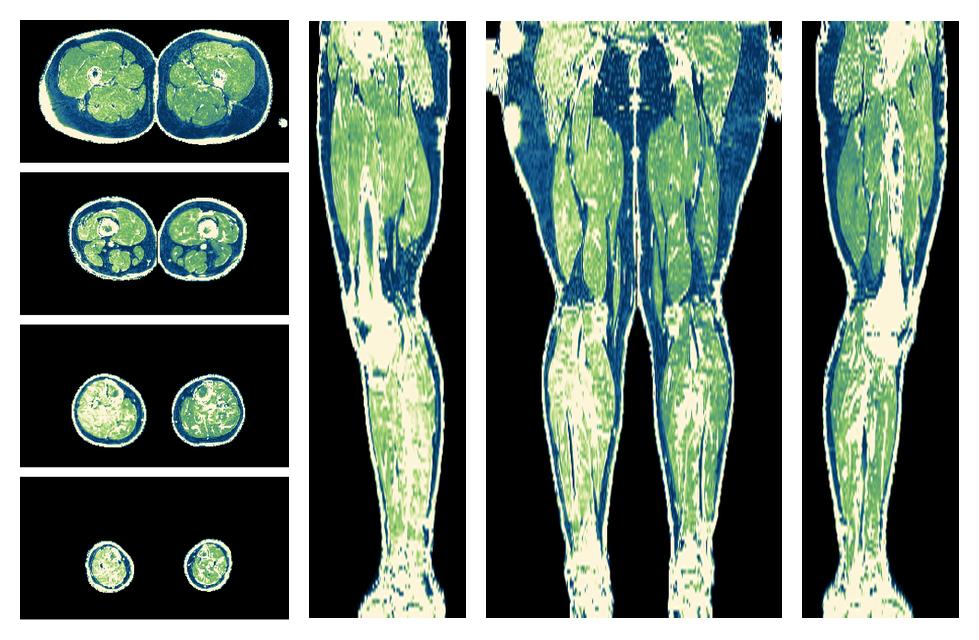 The R2 star relaxation time of the lower extremity obtained from the dixon reconstruction for muscle water fat quantification.